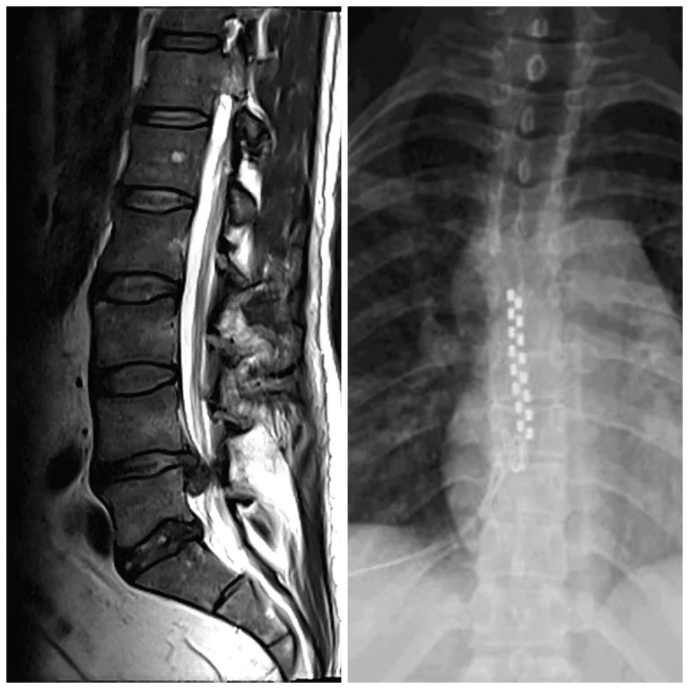 MRI and X-ray images of the spine showing hardware along the vertebral column.
