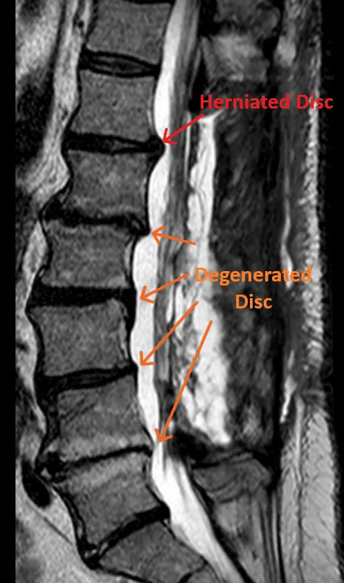 MRI of the spine highlighting herniated and degenerated discs.