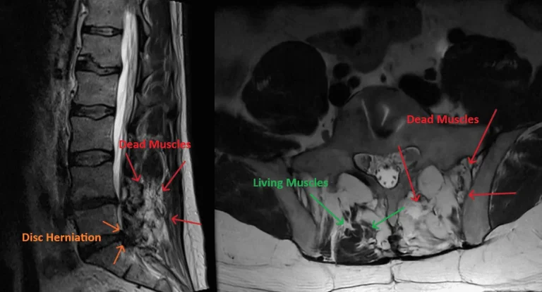 MRI scans show disc herniation and differences between dead and living muscles with labeled arrows.