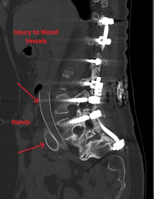 CT scan showing spinal hardware with labeled blood vessel injury and stents.
