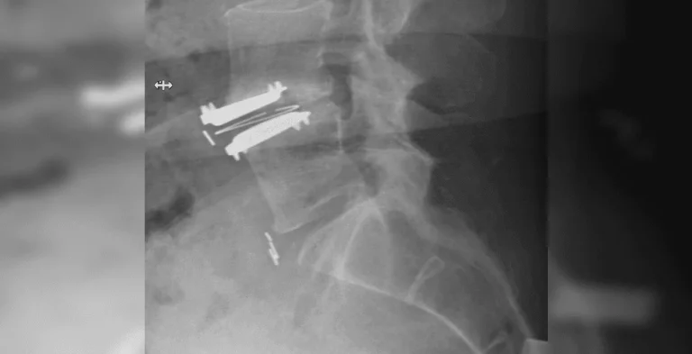 X-ray of a spine with metal screws and plates inserted.