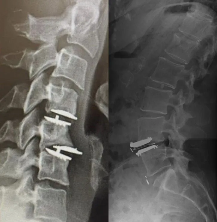 Side-by-side spinal X-rays showing vertebrae with surgical screws inserted.