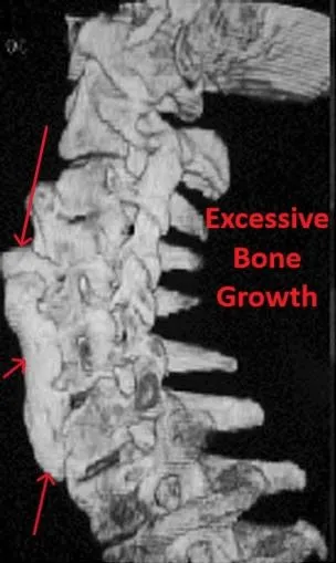 X-ray of a spine showing excessive bone growth, indicated by arrows and labeled text.