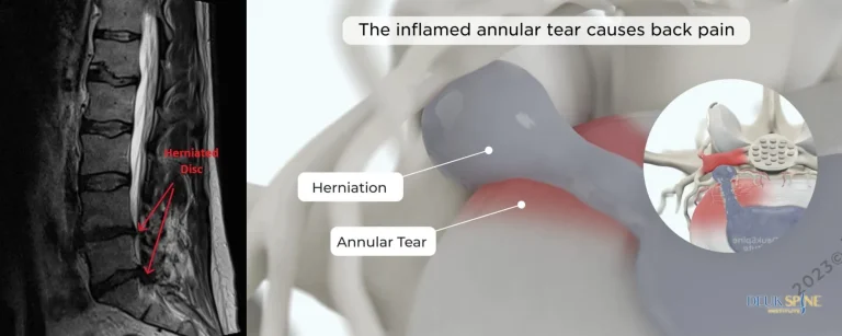 MRI and diagram show a herniated disc and annular tear causing back pain.