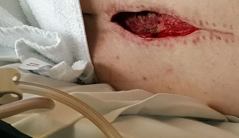 Close-up of an open surgical wound on a person's skin.