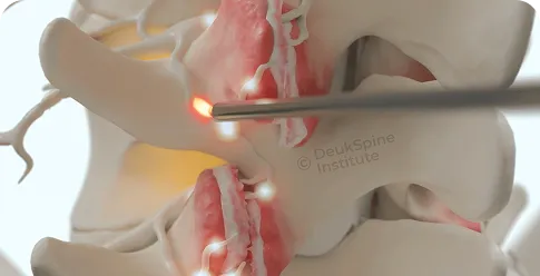 Illustration of a spine procedure highlighting a targeted area with a glowing tool.
