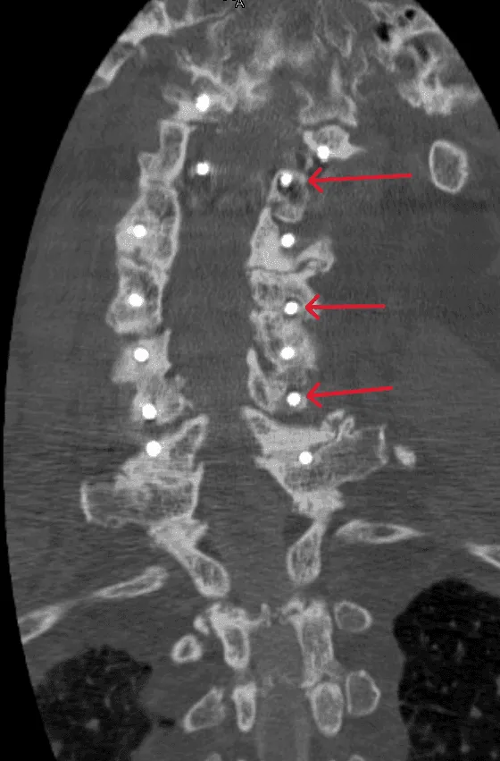 CT scan showing a spine with highlighted vertebrae indicated by red arrows.