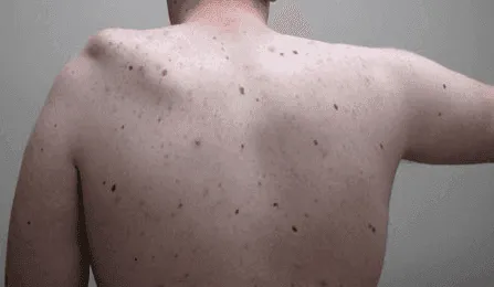 Back view of a person with multiple moles and freckles on their skin.