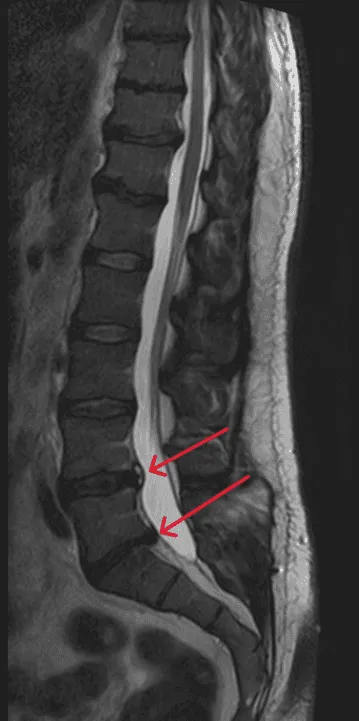 MRI of the lumbar spine with red arrows indicating areas of interest.