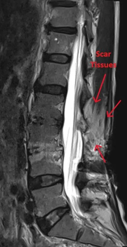 MRI scan showing scar tissue in the lumbar spine, labeled with arrows.