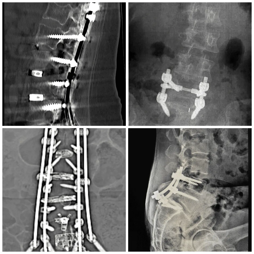 A collage of fusion ladders indicating that additional surgeries are always necessary after spinal fusion.