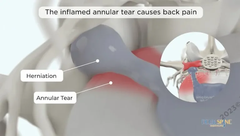 Diagram illustrating an inflamed annular tear and herniation causing back pain.