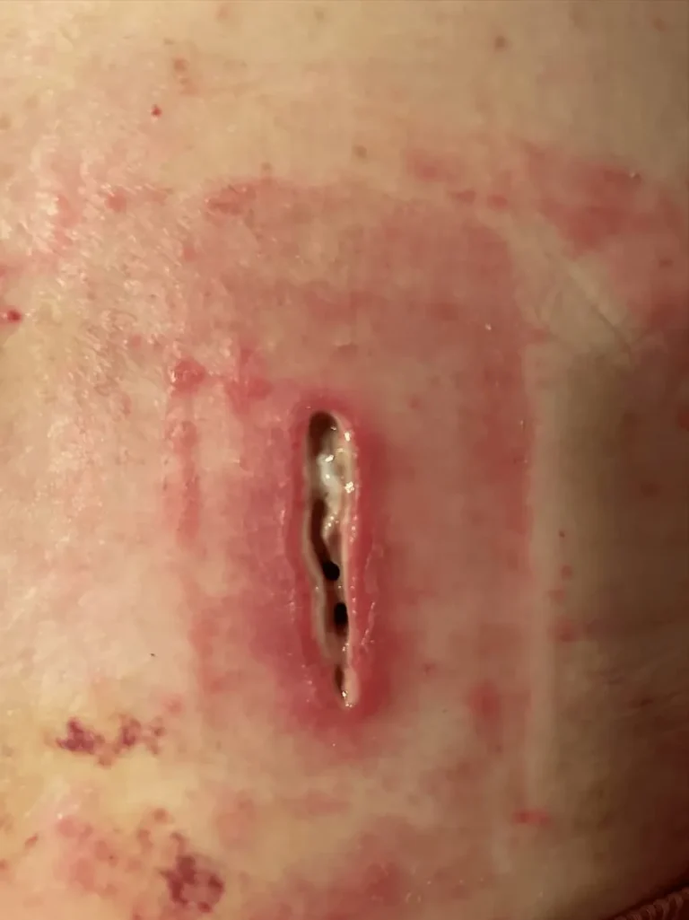 A red, inflamed area on skin with a vertical wound.