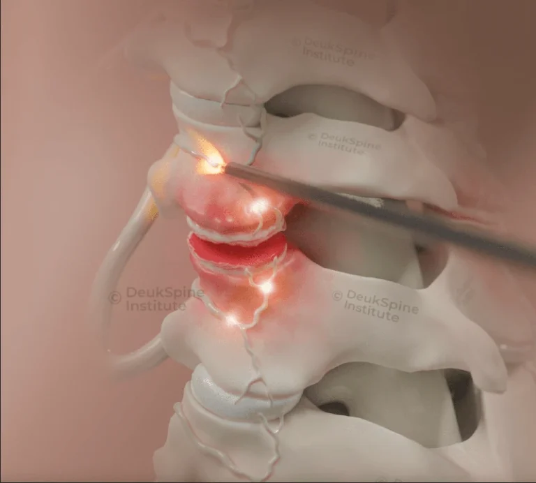Benefits of Cervical Deuk Plasma Rhizotomy
