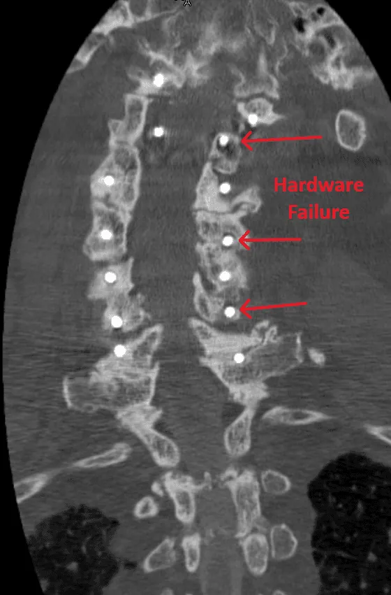 CT scan of a spine showing hardware failure with arrows pointing to specific areas.