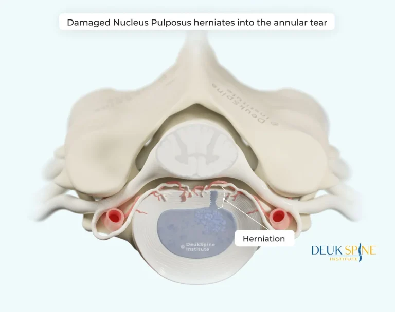Illustration of a spinal disc herniation with labeled nucleus pulposus protrusion.
