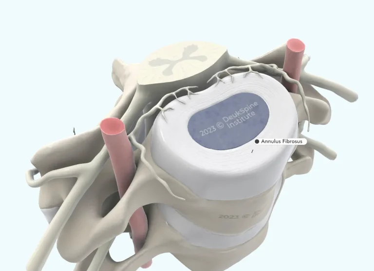 D spine model showing the annulus fibrosus of an intervertebral disc labeled.