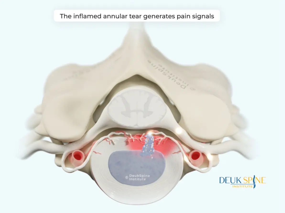Illustration of an inflamed annular tear generating pain signals in a spinal disc.