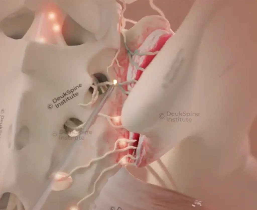 Illustration of a spinal procedure with highlighted nerves and surgical instrument.