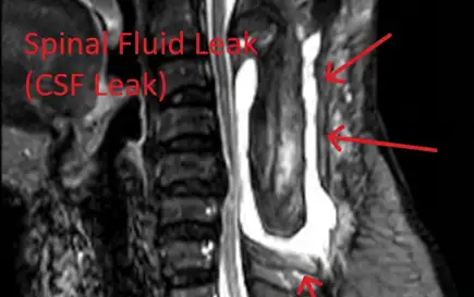 MRI scan showing a spinal fluid leak with annotations and red arrows indicating the affected area.