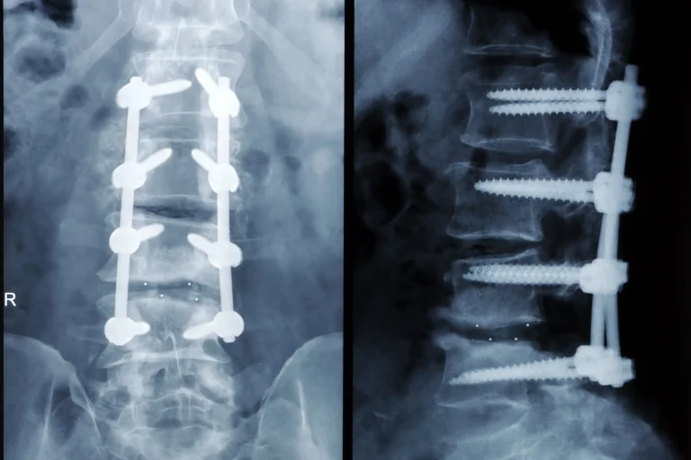 Spinal Fusion Surgery X-ray images showing spinal fusion with screws and rods.