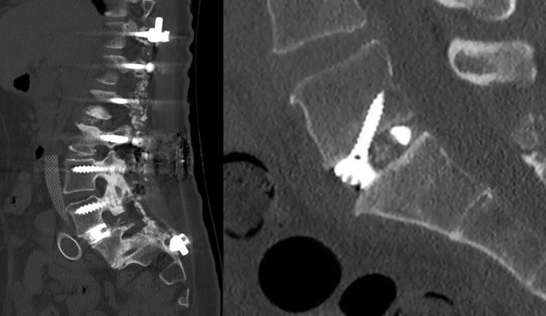 CT scan showing spinal instrumentation with screws and rods in place.