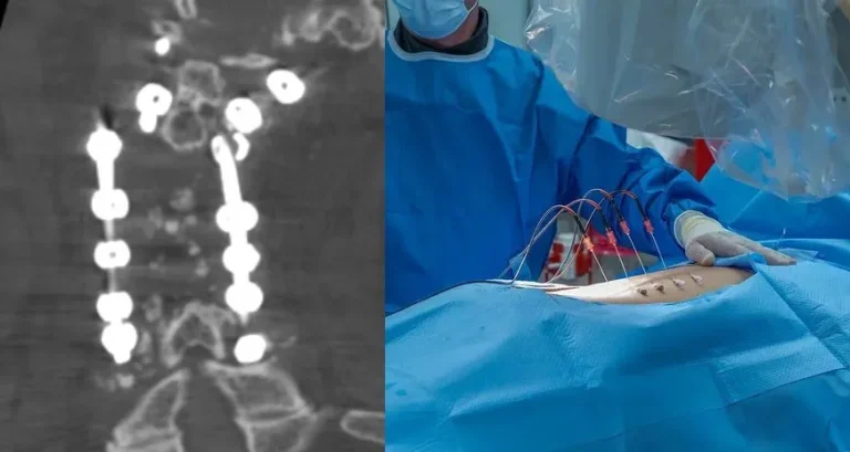 Spinal surgery image with X-ray of metal implants and a surgeon operating on a patient.