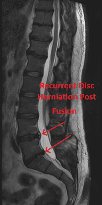 MRI showing recurrent disc herniation with labels indicating the affected area.