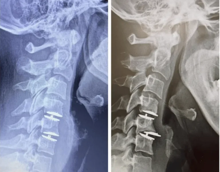 Two X-rays of a neck showing spinal screws in the vertebrae.