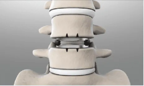 Example of an artificial disc placed in between vertebrae