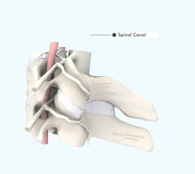 Illustration of a section of the spine highlighting the spinal canal.