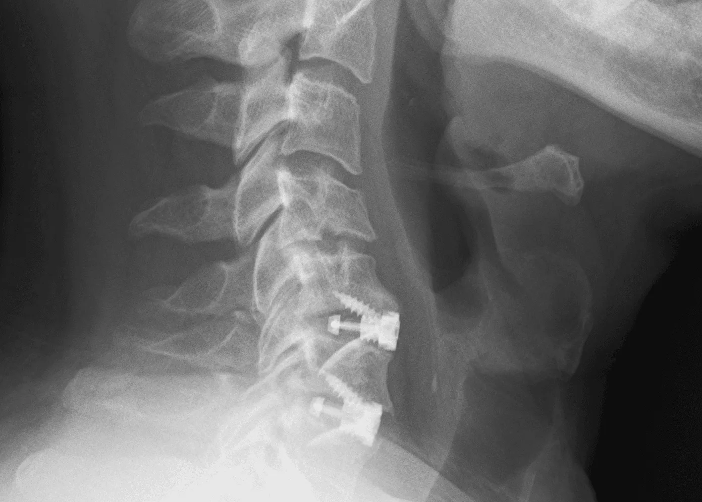 Xray image of a neck with a metal cage placed during ACDF surgery.
