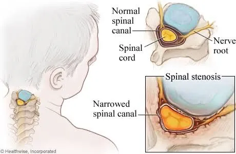 Illustration comparing normal spinal canal and spinal stenosis in a human neck.