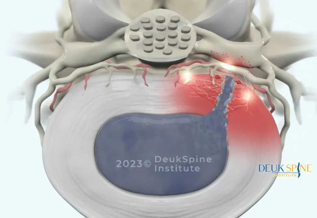 Illustration of a herniated disc with inflammation and nerve impingement.