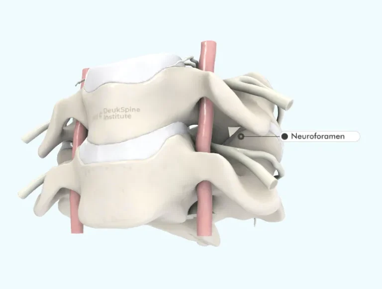 Illustration of vertebrae and discs with neuroforamen labeled.