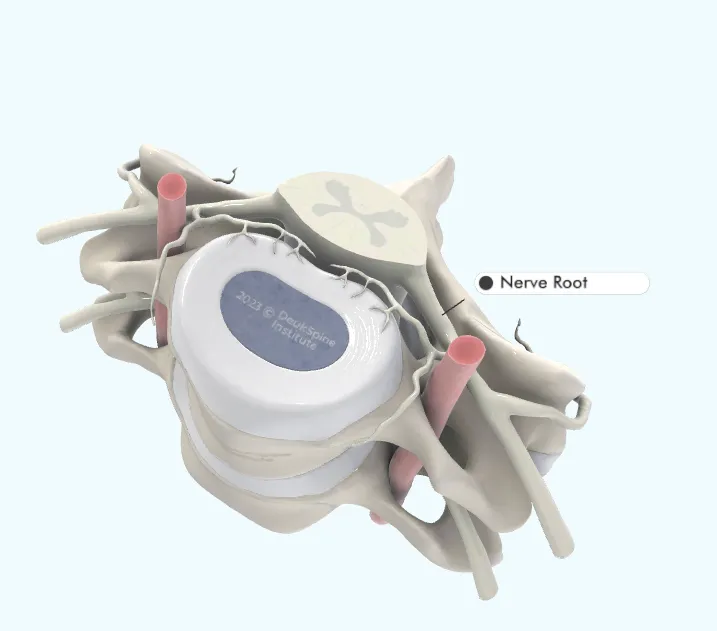 D model of a vertebra with highlighted nerve root.