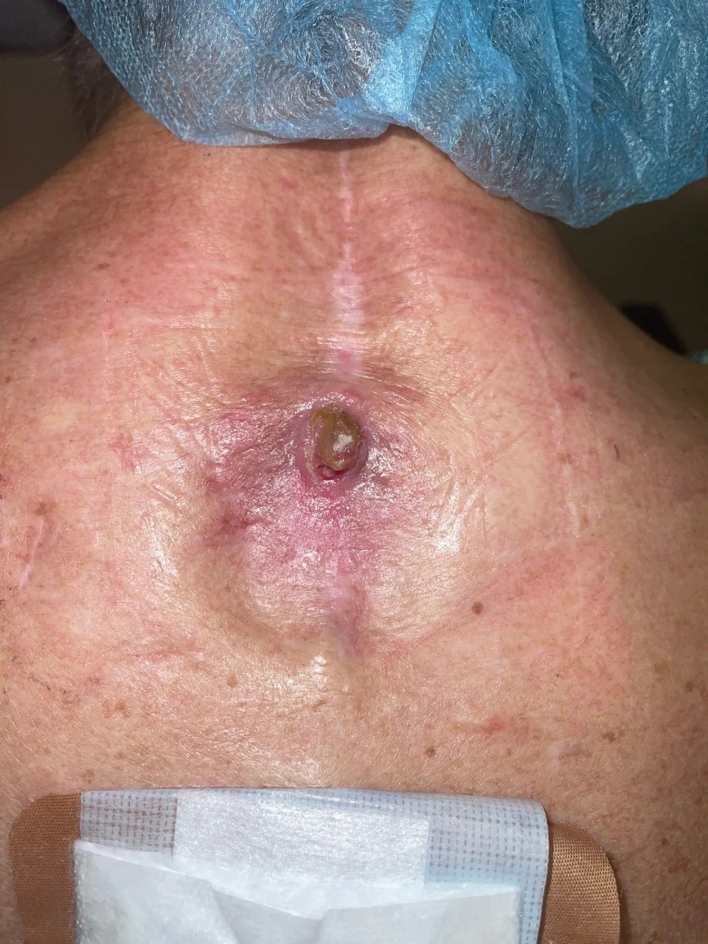 Patient with advanced infection a laminectomy wound site