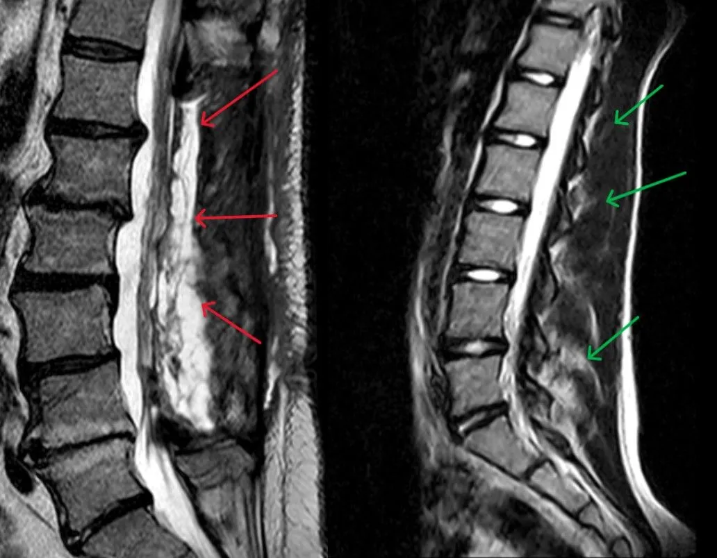 #Laminectomy-MuscleDamage-Annotated.jpg