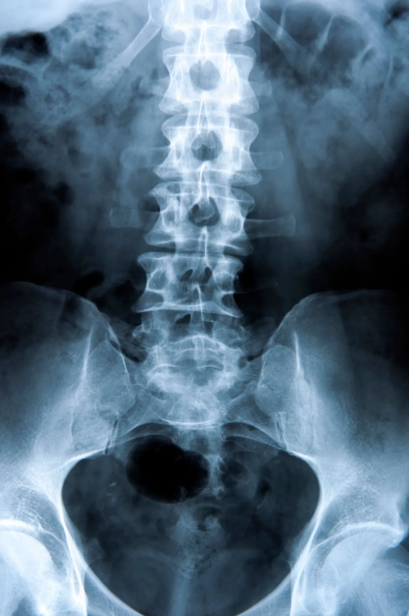 X-ray of a spine showing scoliosis