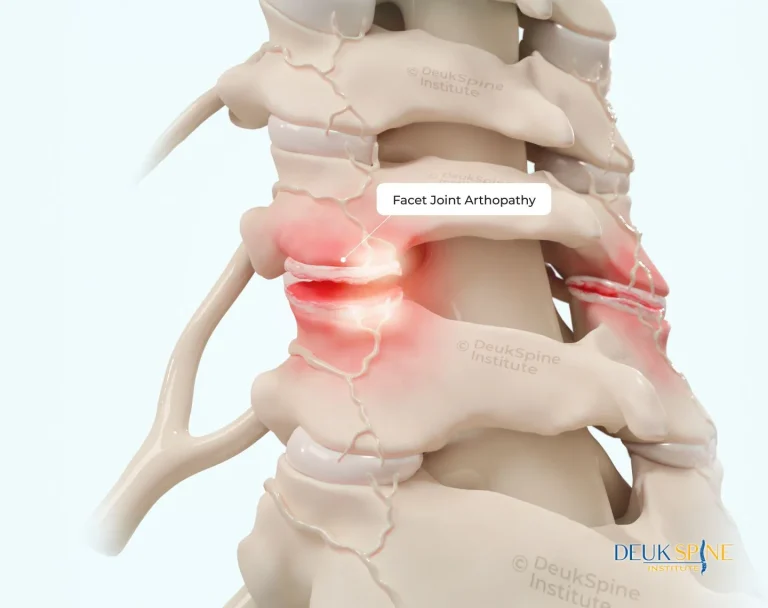 Illustration of facet joint arthropathy in the spine, showing inflamed red areas.