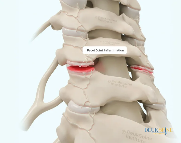Illustration of a spine showing facet joint inflammation in red.