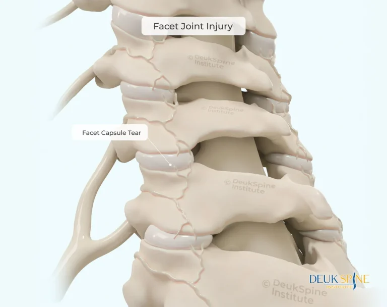Illustration showing a spine with highlighted facet joint injury and facet capsule tear.