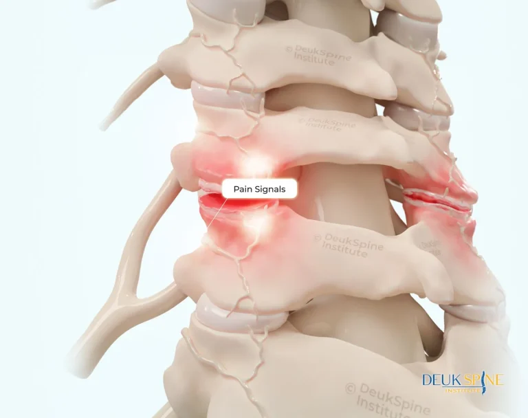 Illustration of a spine segment showing highlighted areas with "Pain Signals" labeled.