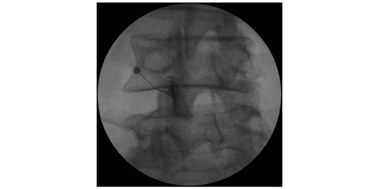 X-ray image showing the placement of a needle in the spine during a medical procedure.