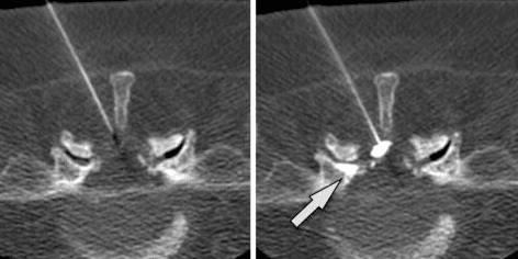 CT scan of a spine shows a needle targeting a spinal area, with an arrow indicating the entry point.