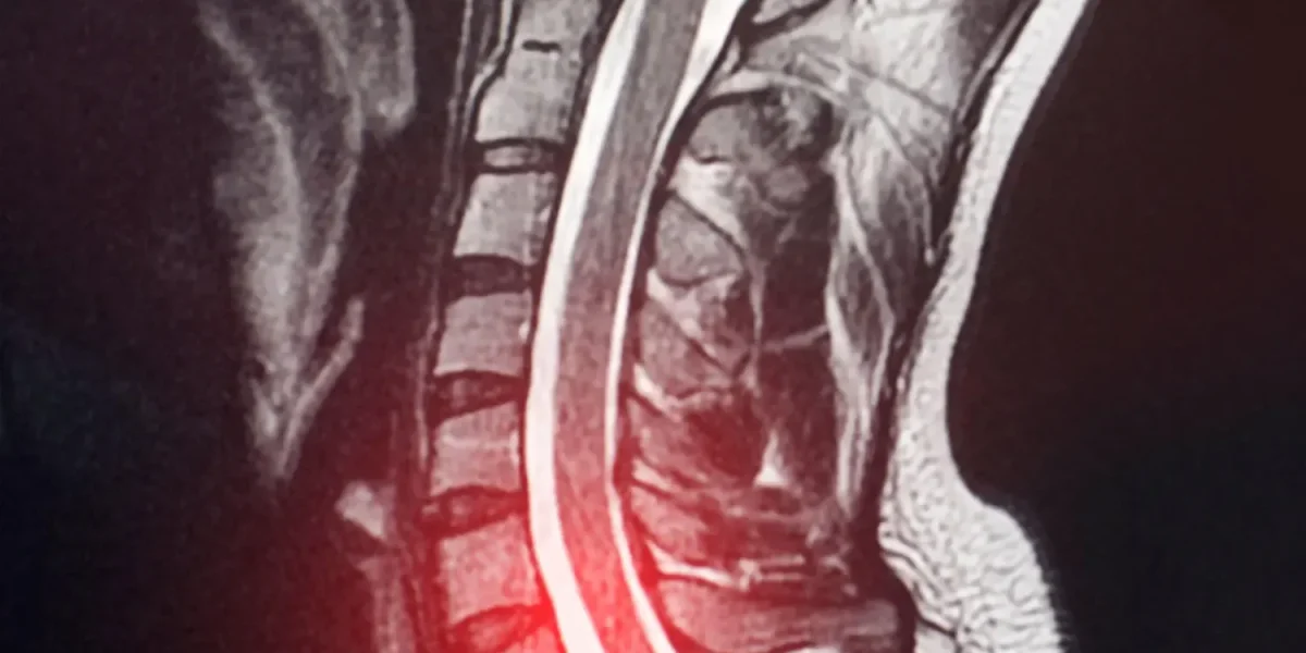 C6-C7 Disc Herniation MRI Showing Cervical Spine Compression