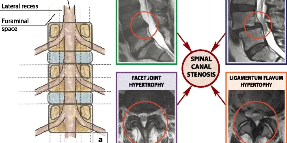 Diagram showcasing facet hypertrophy along with other conditions like Disc herniation, spondylolisthesis and ligamentum flavum hypertrophy.