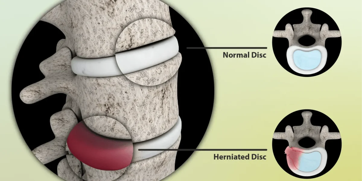 An animation showing both normal and the herniated disc.