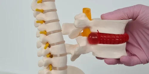A model of a human spine with a gloved hand holding a vertebra segment showing a red herniated disc.