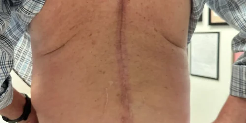 A patient who underwent laminectomy showcasing his large incision scar on his lower back.